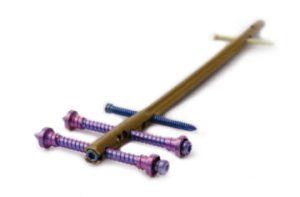 CHARFIX2 condylar retrograde femoral nail