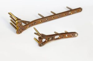 5.0ChLP proximal tibia plates