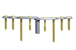 pubic symphysis plates