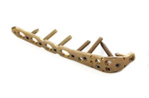 5.0ChLP olecranon plate