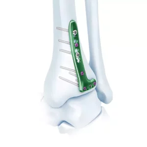 VA Distal Tibia Locking L-Plate