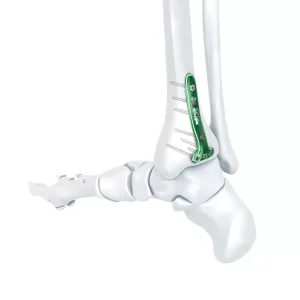 VA Distal Tibia Locking T-Plate
