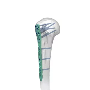 Proximal Humeral Locking Plate